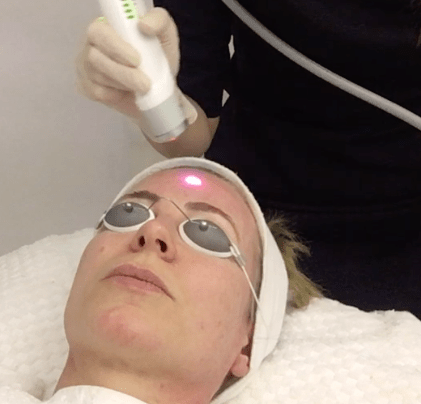 laser facial lasergenesis