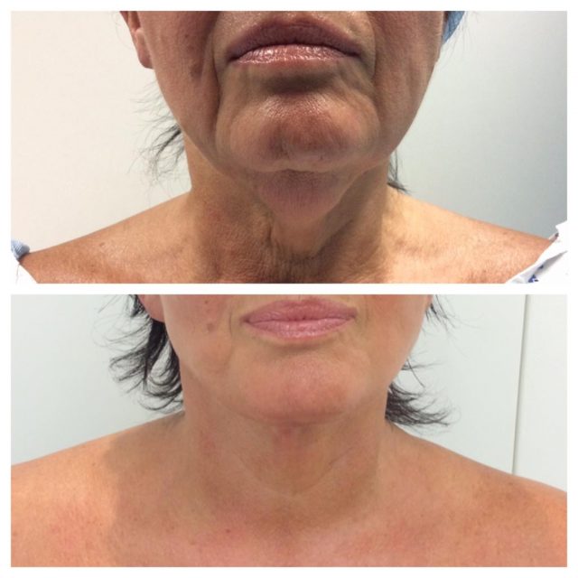 Treatment for neck wrinkles and sagging jawline 