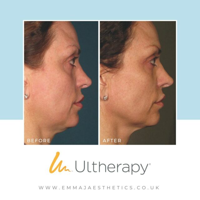 Results of Ultherapy