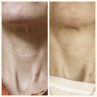 Profhilo neck before and after 2018 low res