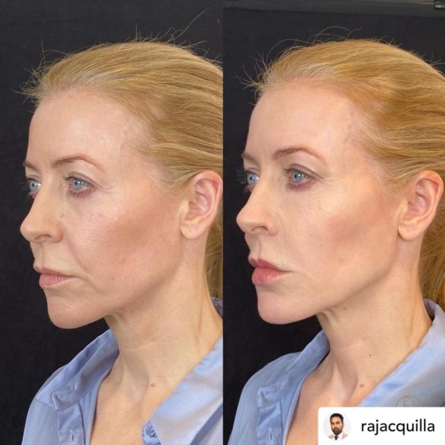 Woman's face before and after dermal filler treatment 