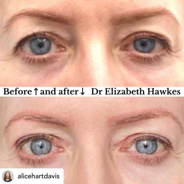 Alice Surgical upper eye lift and ptosis drooping correction 