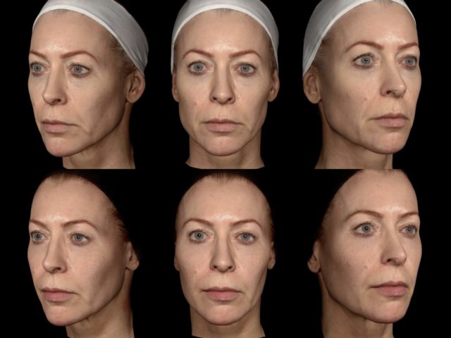 3D images before and after Endolift treatment 