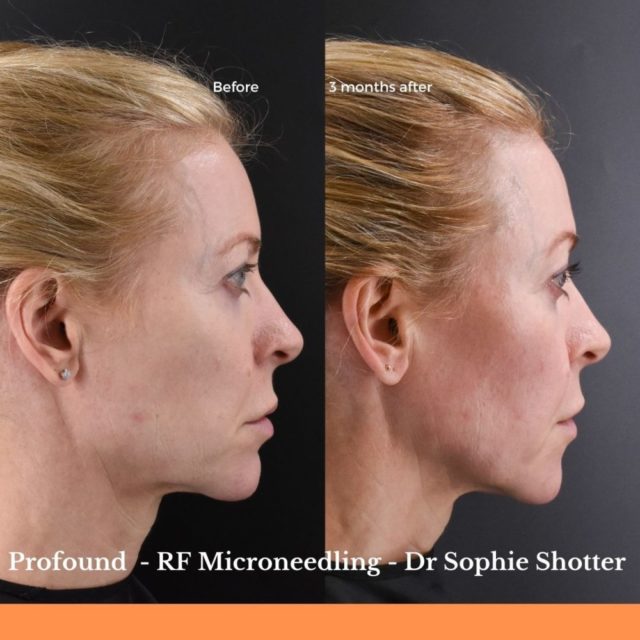 Alice Hart-Davis face profile before and after Profound RF microneedling