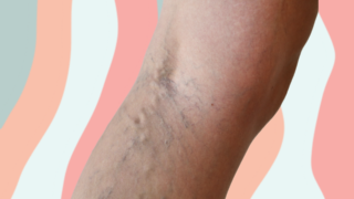 Which thread vein treatment is right for you