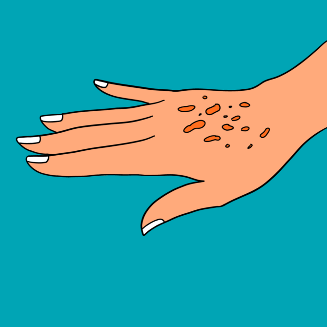 Age Spots on hands