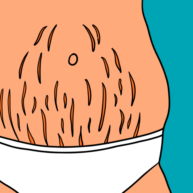 Stretch Marks: Why They Appear And How To Get Rid Of Them With Sylfirm X